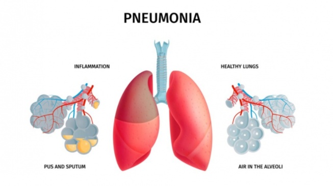 10 Simptom Mycoplasma Pneumoniae, Penyakit Sangat Membahayakan Sudah Masuk Indonesia!