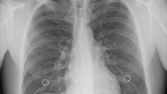 Dinkes DKI Konfirmasi 3 Kasus Pneumonia Mycoplasma di tempat pada Ibukota Sudah Sembuh, Hal ini Respons Kemenkes