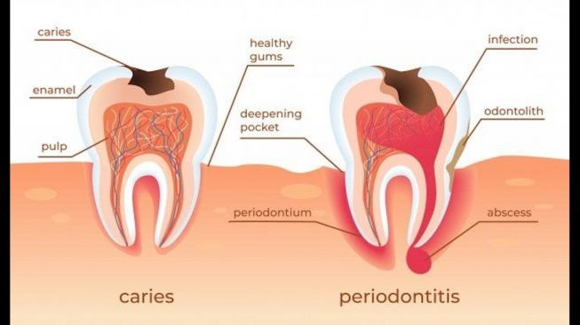 Jangan Anggap Remeh Gigi Berlubang, Dokter Gigi Sebut Bisa Berakhir Maut