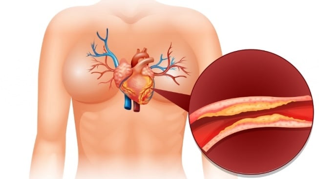 Tips Hindari Nyeri Dada Berulang pada Pasien Penyakit Jantung yang yang disebutkan Sudah Pasang Ring